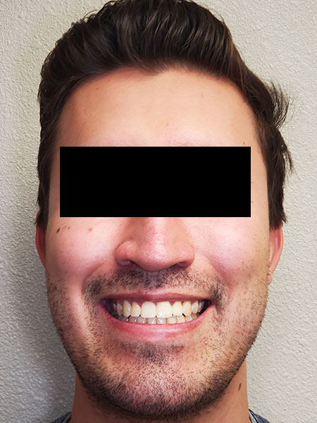Picture of a man  after jaw surgery