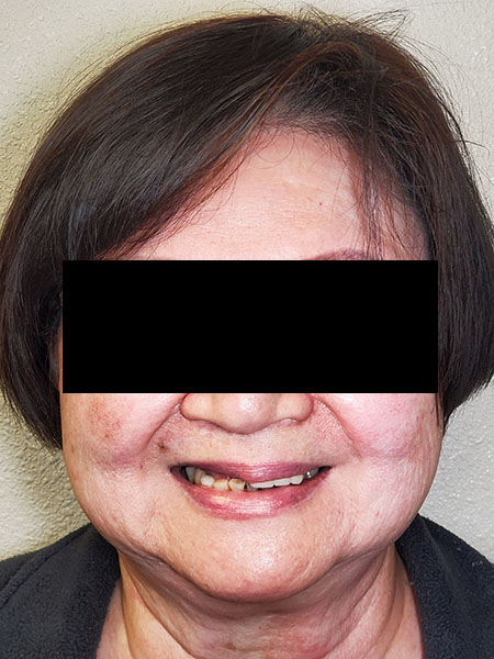 Picture of a woman  before jaw surgery