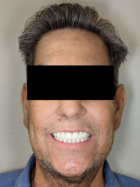 Picture of a man after oral surgery