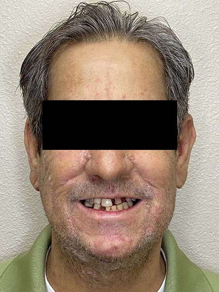 Picture of a man before oral surgery