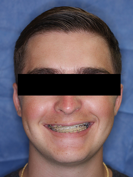 Picture of a man  before jaw surgery
