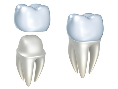 Illustration of a dental crown being applied