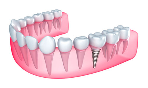 3 Ways In Which Dental Implants Healing Abutments Work