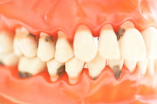 Illustraion of mouth with gum disease and gingivitis by Surf City Oral and Maxillofacial Surgery in Huntington Beach, CA