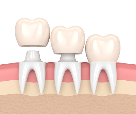 Illustration of  tooth getting a dental crown