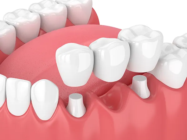 3D rendering of a dental bridge being placed over a missing tooth gap that is flanked by two shaved