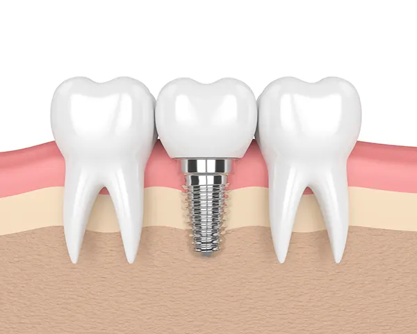 3D rendered cross-section view of a dental implant placed in the jaw between two healthy teeth illustrated at Surf City Oral and Maxillofacial Surgery in Huntington Beach, CA