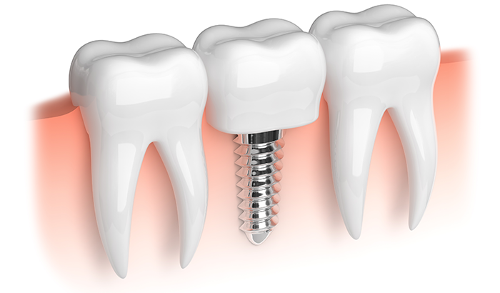 Close up diagram of two teeth and a dental implant by Surf City Oral and Maxillofacial Surgery in Huntington Beach